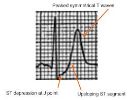 Diagnostic criteria for dewinter t waves. De Winter S T Waves Resus
