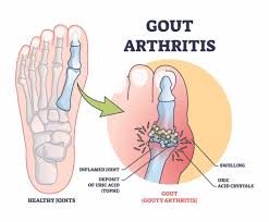 Image result for gout