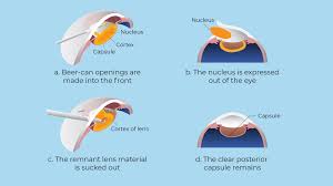Image result for Cataract Extraction