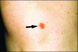 We did not find results for: Cutaneous Sarcoidosis A Dermatologic Masquerader American Family Physician