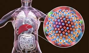 Hepatitis means inflammation of the liver. Hepatitis Info Centre Helmholtz Centre For Infection Research