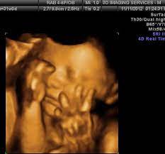 3 D Ultrasounds Cause Concern For Obgyn Doctors And Fda Cbs News