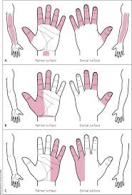 Image result for Carpal Compression Test