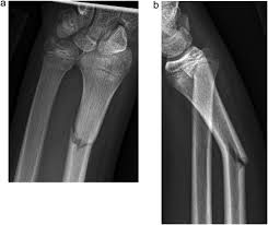 Image result for Galeazzi Sign