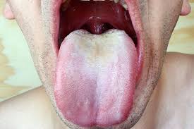 What Is Thrush And What Are Its Signs And Symptoms Hsg Com Yeast Infection Treatment Treat Yeast Infection Yeast Infection On Skin