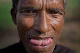 on a disease that has decimated