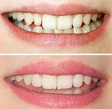 Ein weiteres hausmittel, das hellere zähne verspricht, ist ölziehen. Weisse Zahne Diese Tipps Zaubern Ein Strahlendes Lacheln Welt