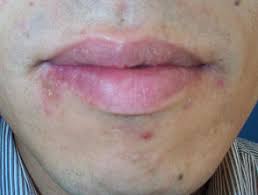 Here are few pictures of herpes on a face, if you notice these symptoms on your face then you must visit the doctor. Herpes Simplex Images Dermnet Nz
