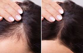 Coda cavallina per stimolare la crescita dei capelli la coda cavallina è una pianta molto conosciuta per il suo elevato contenuto di silicio, un minerale che rinforza i capelli, le unghie e le ossa. Come Accelerare La Crescita Dei Capelli Con La Ricetta Fai Da Te