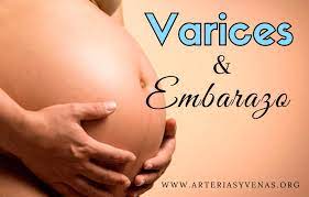 Varices En El Embarazo Arterias Y Venas