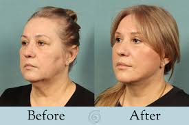 Facelift Before and After