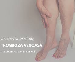 Przejdź do nawigacji przejdź do wyszukiwania. Tromboza VenoasÄƒ Se Dr Marina Dumitras Chirurg Facebook