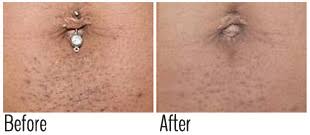 Cysts bumps and abscesses everything you need to know. Ingrown Hair Removal Nyc Ingrown Hair Treatment Brooklyn