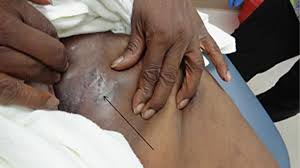 Image result for sore skin in the groin area