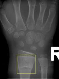 We did not find results for: A Buckle Fracture Of The Distal Radius The Classification Is Download Scientific Diagram