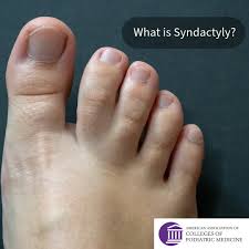 Image result for Syndactyly