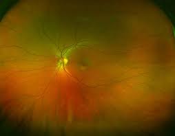 Tearing of the retina may produce retinal or vitreous hemorrhages. Optomap Ultra Widefield Retinal Imaging Family Vision Center