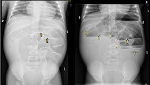 Image result for Adynamic Ileus