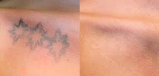 Maybe you would like to learn more about one of these? Picosure Tattoo Removal Anna Avaliani Md Cosmetic Laser Surgery Anna Avaliani Md Cosmetic Laser Surgery