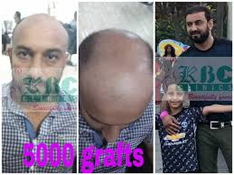 Aamir Khan Aamirkh22798550 Twitter Am afzal hussain worried a lot due to hair fall, when i met with dr.