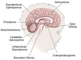 childhood brain cancer tumor medulloblastomas