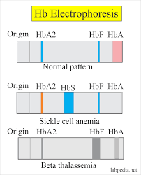 Haemoglobin Part 2 Haemoglobin Electrophoresis Hb