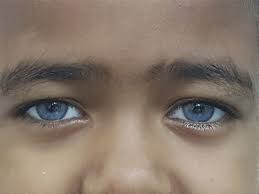 Teaching Neuroimages Waardenburg Syndrome Type 2 Neurology