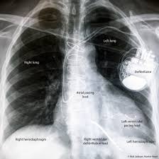 Published on september 29, 2014. Implantable Cardioverter Defibrillators Icds And Cardiac Resynchronisation Therapy Crt Hunter Cardiology