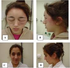 O'dell isn't the first to have such an intense reaction to ppd. Hair Dye Allergy A Coloured Case Springerlink