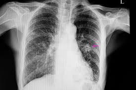 Image result for Pneumonia