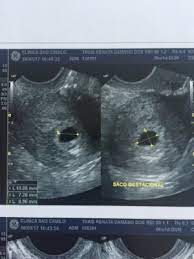 Beta Alto E Ultra De 4 Semanas Janeiro De 2018 Babycenter