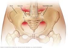 Image result for icd 9 code for sacroiliac joint dysfunction