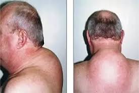 Cortisol - Cushing Syndrome - Dr. Qaisar Ahmed MD, DHMS