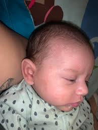 Im a first time mom and my baby is 1 month old. How to deal with this. Its  all over his face. Any recommendations or suggestions 🙏🏻