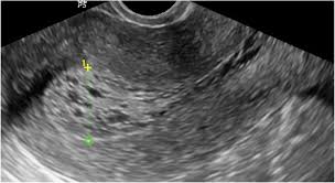 An early diagnosis can make a world of difference when treating cancer. Role Of Transvaginal Ultrasound In Detection Of Endometrial Changes In Breast Cancer Patients Under Hormonal Therapy Egyptian Journal Of Radiology And Nuclear Medicine Full Text