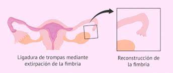 Es Reversible La Ligadura De Las Trompas De Falopio