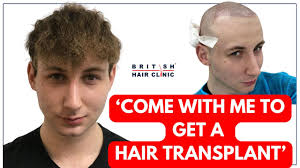Come with me to get a hair transplant