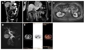 As pancreatic carcinoma is a hypovascular tumor, it presents as a hypodens mass on a cect. Challenges In Diagnosis Of Pancreatic Cancer