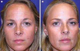 Información actualizada sobre la vacunación de pacientes en arizona. El Lado Oscuro Del Botox Del Entrecejo Al Engano