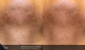 Check spelling or type a new query. Permanent Hair Removal Face Back Neck Bikini Body Face Murfreesboro Tn