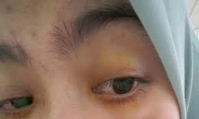 Mata yang mudah berair dan terasa berbayang. Mata Pedih Kabur Dan Berair Mata Gadis Rosak Selepas Pakai Contact Lens Ini Lobak Merah