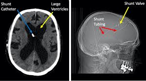 Image result for Hydrocephalus