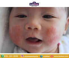 Jun 26, 2021 · kretinisme dapat diobati dengna pemberian hormone tiroid asalkan tidak terlambat. Bintik Merah Pada Bayi Lulubae