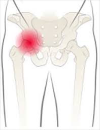 The thigh bone or femur and the pelvis join to form the hip joint. Diagnosis International Hip Dysplasia Institute