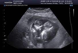 Twins At 12 Weeks 12 Semanas De Embarazo Ultrasonido Ecografia De 12 Semanas