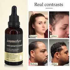 Shikakai mixed with curd acts as a great natural hair cleanser to clean hair and scalp. Hair Loss Products And Fast Hair Growth Remedy Essence Oil Natural Extracts Liquid Hair Regrowth Products Treatment Solutions 7556963 2021 11 43