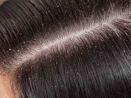 All hair loss is awful, but rapid hair loss often feels like it comes out of nowhere and comes on fast. Dandruff Leads To Hair Loss How Does Excess Dandruff Cause Too Much Hair Fall Lifealth