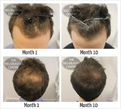 In lower doses of radiation, the hair will generally grow back in 3 to 6 months after the final radiation session. How Long Does It Take To See Results From Hair Loss Treatments