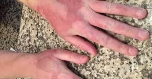 Image result for Photodermatitis