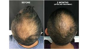 Keha has its own standardized method of prp hair loss treatment which is very effective. Prp Therapy In Nepal Aavaran Skin And Hair Clinic